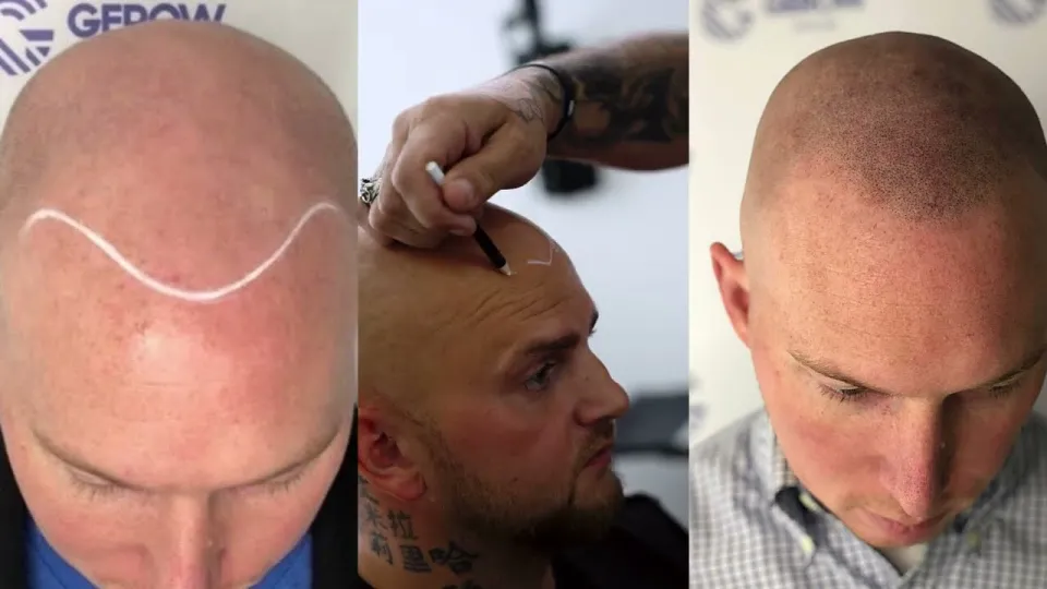 5 Effective Steps for Best Hairloss Solution in NYC
